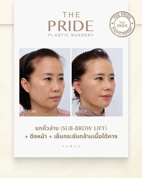 The Pride Plastic Surgery — ยกกระชับ sub-brow + facelift + มัดกล้ามเนื้อใต้คาง