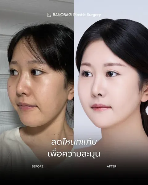 Banobagi Plastic Surgery — โครงหน้า 3 จุดล่าสุด