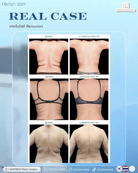 Banobagi Plastic Surgery — Renuvion: ข้อมูลอุปกรณ์และบริเวณที่ทำ
