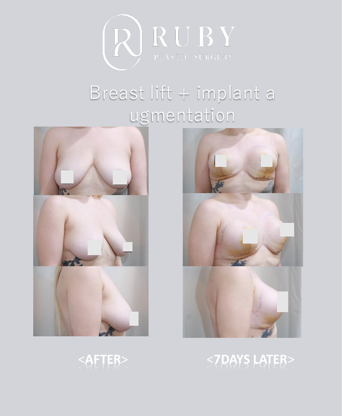 Breast2.pdf — 4