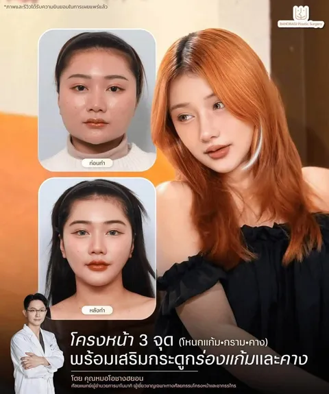 Banobagi Plastic Surgery — โครงหน้า 3 จุด ก่อน → หลัง