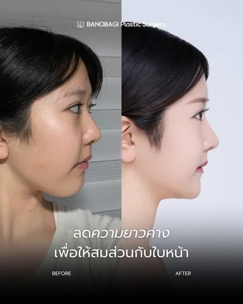 Banobagi Plastic Surgery — โครงหน้า 3 จุดล่าสุด