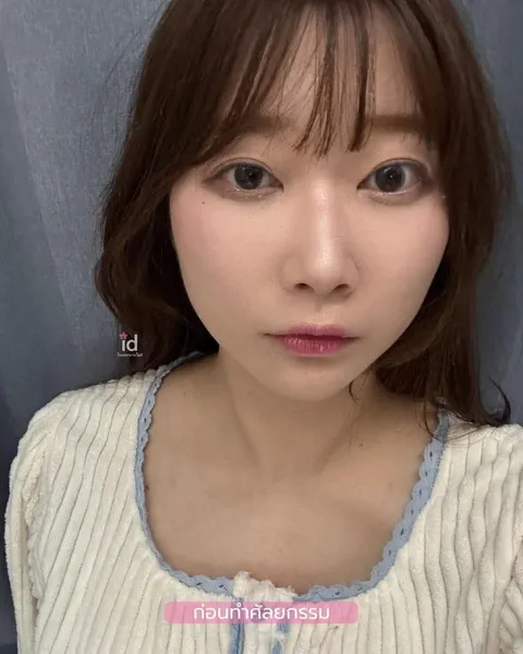 ID Hospital — จมูกผู้หญิง ที่ ID Hospital