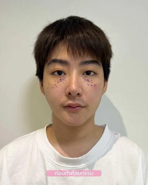 ID Hospital — จมูกผู้ชาย ที่ ID Hospital