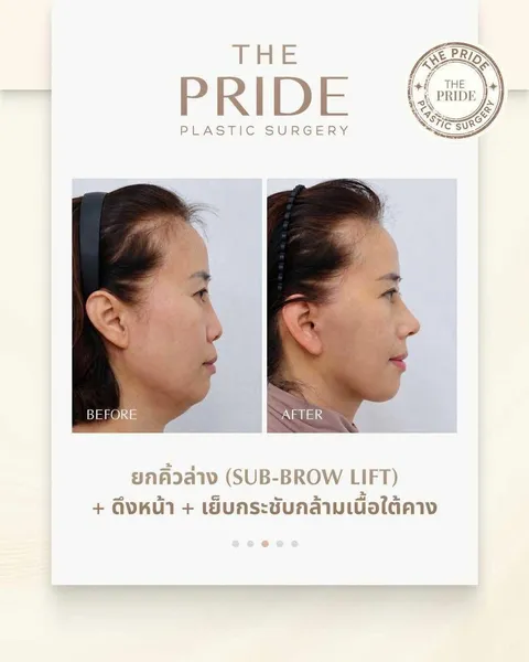 The Pride Plastic Surgery — ยกกระชับ sub-brow + facelift + มัดกล้ามเนื้อใต้คาง