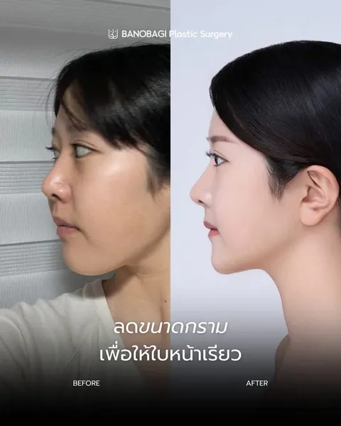 Banobagi Plastic Surgery — โครงหน้า 3 จุดล่าสุด