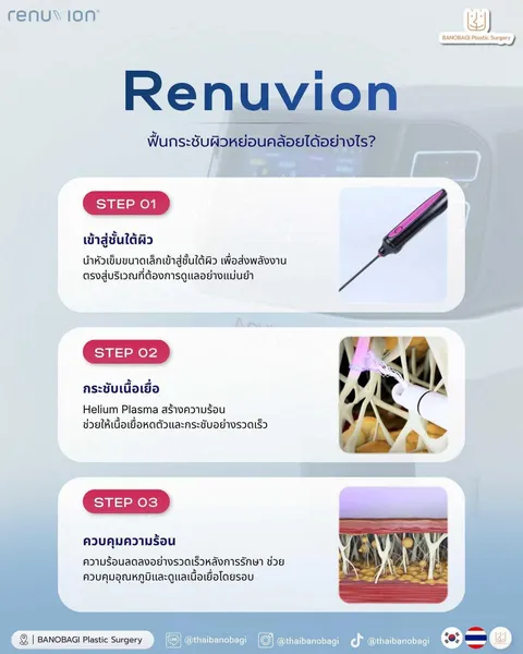 Banobagi Plastic Surgery — Renuvion: ข้อมูลอุปกรณ์และบริเวณที่ทำ